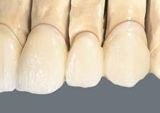 Vrstvení BASIC Závěrečné korekce tvaru proveďte směrem od oblasti krčku hmotou BASE DENTINE a v oblasti těla až k oblasti incise hmotou ENAMEL. Doporučený postup při 2.