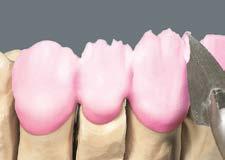 Vrstvení BUILD UP Nanesení VITAVM 9 TRANSPA DENTINE TRANSPA DENTINE se nanáší na