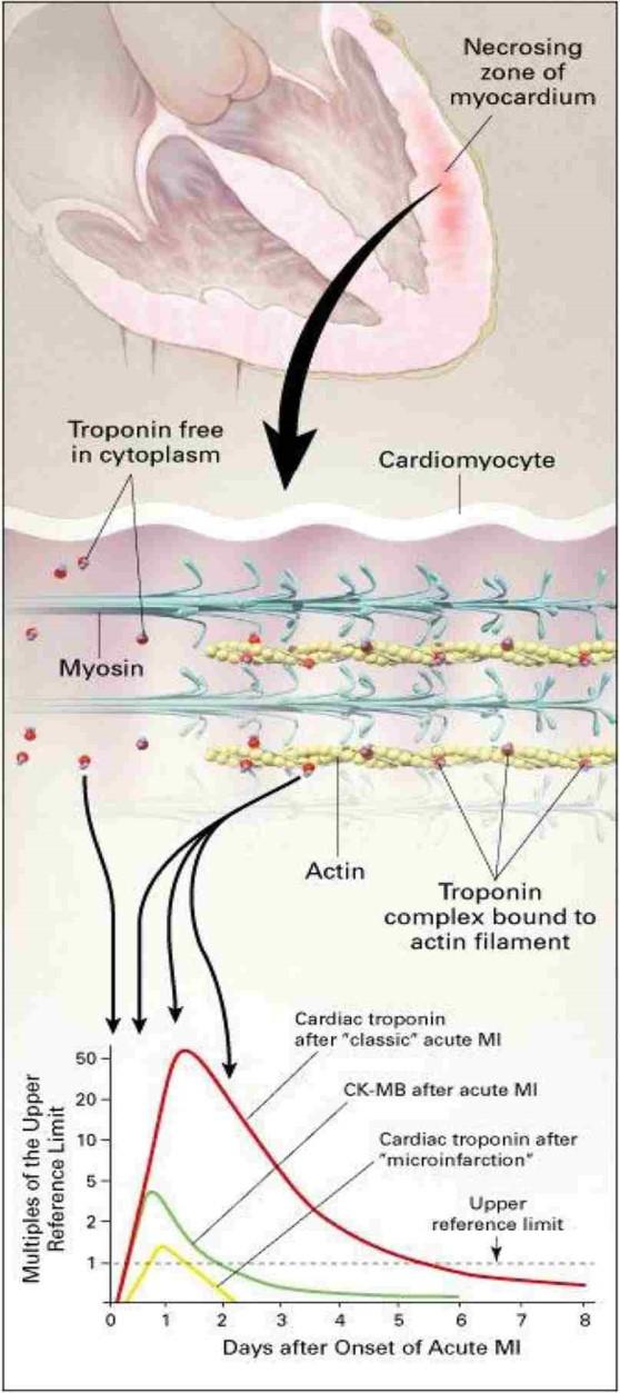 Hlavní výhody srdečních troponinů vysoká specifita - struktura troponin T a I se liší u srdeční a kosterní svaloviny vysoká senzitivita detekce tzv.