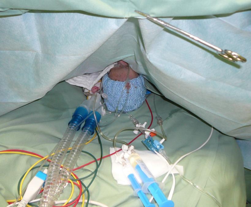 Zajištění pacienta -venepunkce G24, čím menší dítě tím snadnější (překvapivě) -oro či nasotracheální endotracheální intubace (věčný rozpor) -kanylace artérie, nejraději