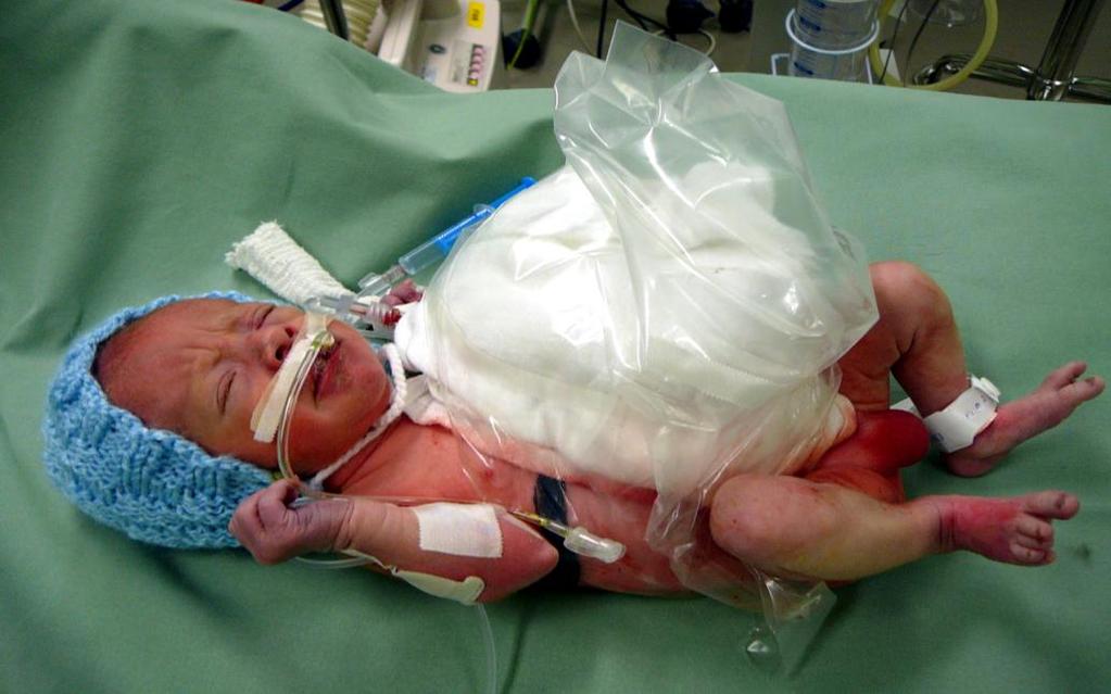 Anestézie novorozence Velmi náročná anesteziologická činnost vyžadující: -