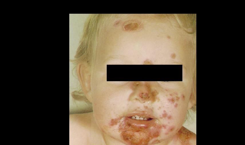 Impetigo