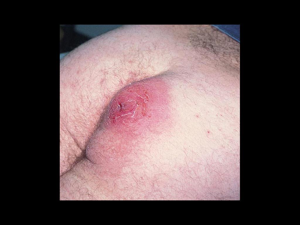 Carbuncle of the buttock caused by Staphylococcus aureus.
