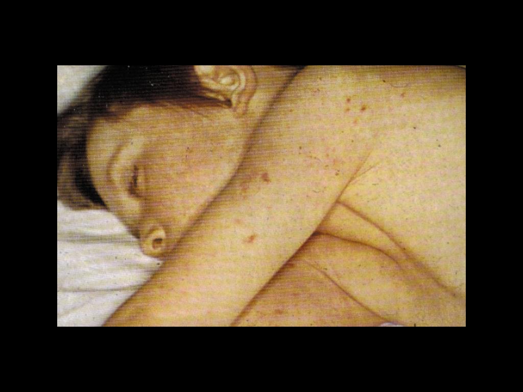 Typical rash of meningococcal septicemia.