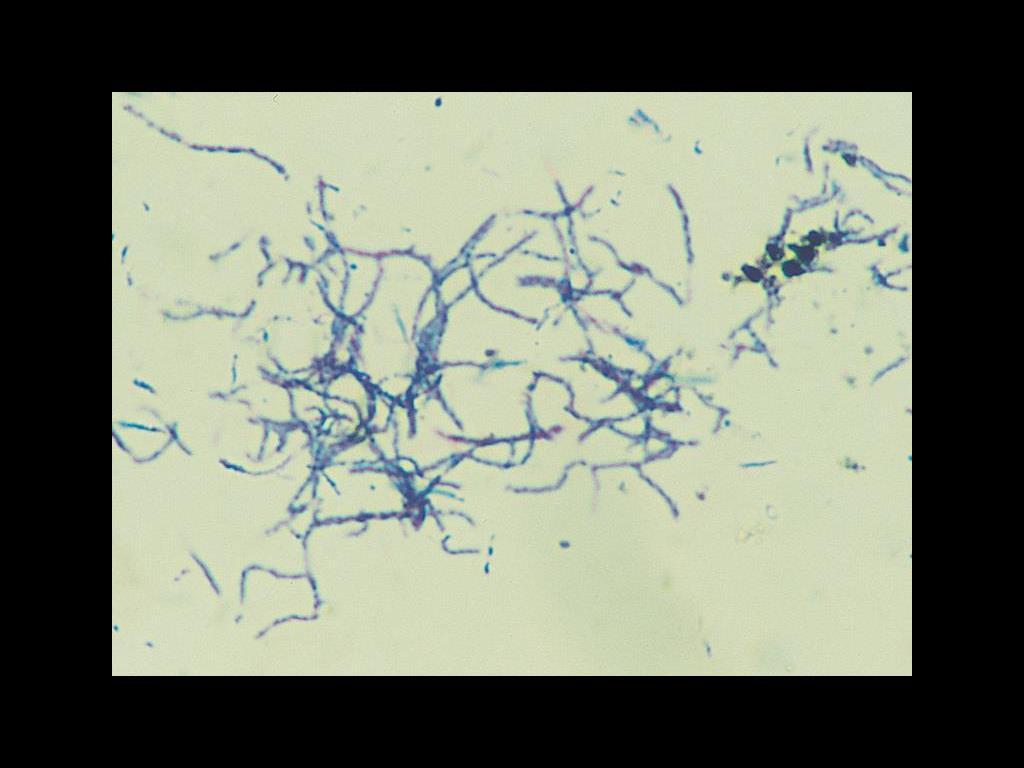 Nocardia asteroides on Gram stain showing extensively