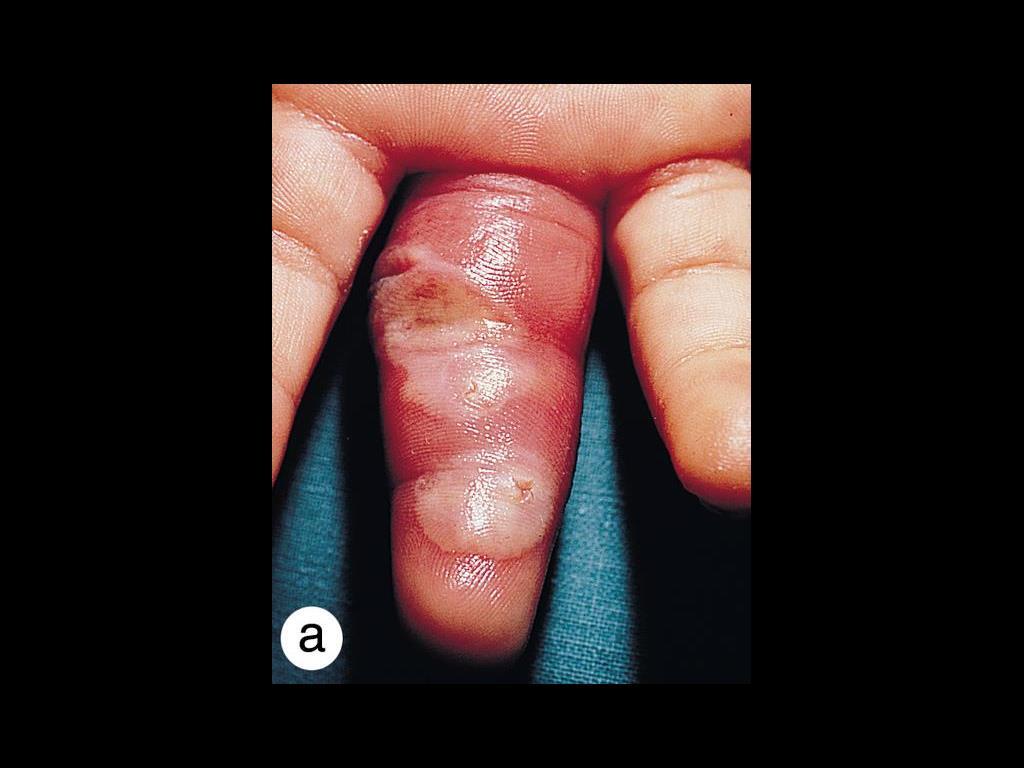 Primary cutaneous nocardial infection is characteristically painless, localized and