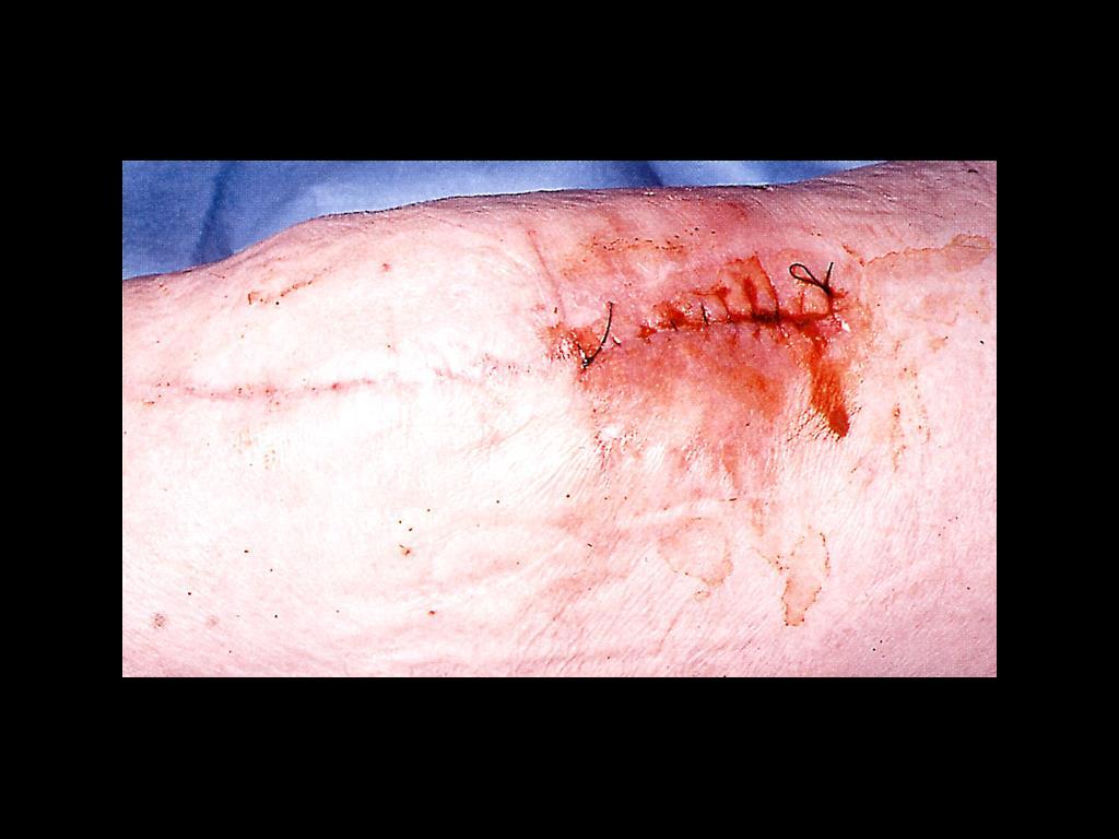 An acutely infected knee replacement. The site was washed out but the infection failed to resolve.