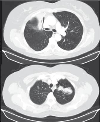 METASTAZUJÍCÍ SVĚTLOBUNĚČNÝ RENÁLNÍ KARCINOM BEZ ZJEVNÉHO PRIMÁRNÍHO LOŽISKA V LEDVINĚ IMITUJÍCÍ POKROČILÉ STADIUM PLICNÍ MALIGNITY KOLEČKOVÁ M., TICHÝ T., MELICHAR B. 2, VEVERKOVÁ L. 3, HES O.