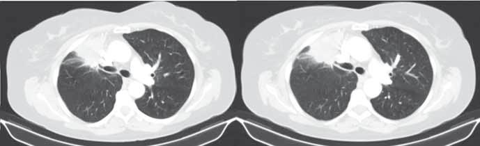 Ústav klinické a molekulární patologie, LF UP a FN Olomouc, 2 Onkologická klinika LF UP a FN Olomouc, 3 Oddělení mamární dia gnostiky, Radiologická klinika LF UP a FN Olomouc, 4 Šiklův ústav