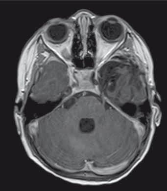 neuroepiteliální tumor/ pilocytární/ pilomyxoidní astrocytom) levého temporálního laloku po opakovaných parciálních resekcích. Dabrafenib s trametinibem od 3/ 208 v.