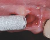 GUIDOR easy-graft