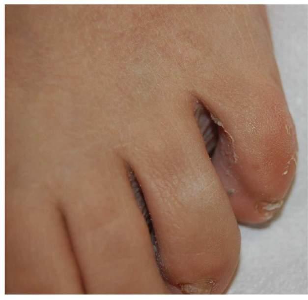 Tinea pedis -často předchází onychomykóze chronické olupování kůže a
