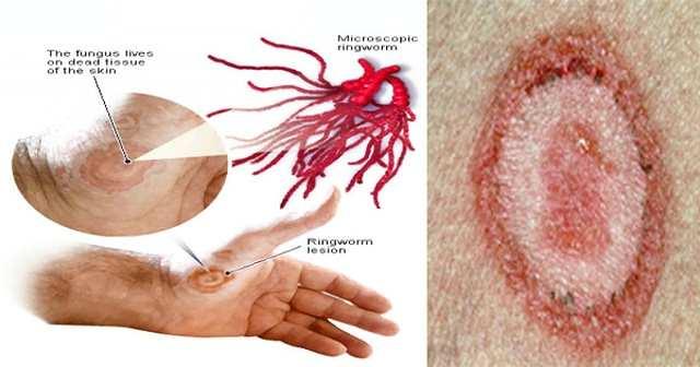 Pojem ringworm fungální infekce kůže s tvorbou kruhových lézí (nebo kruhových lysin - hlava, u zvířat), užíváno v
