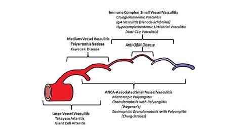 Klasifikace vaskulitid