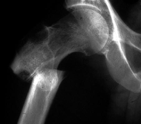 Osteoporóza senilní - stařecká 66% žen