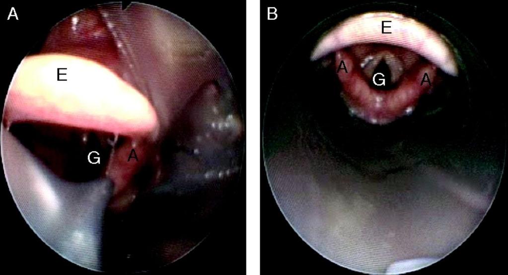 LMA Supreme (ProSeal) studie 23 pacientů s laryngoskopií III nebo IV 100% úspěšnost intubace přes