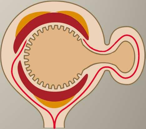 Divertikulóza -terminologie Divertikly kolon -herniacemukózy a submukózypřes