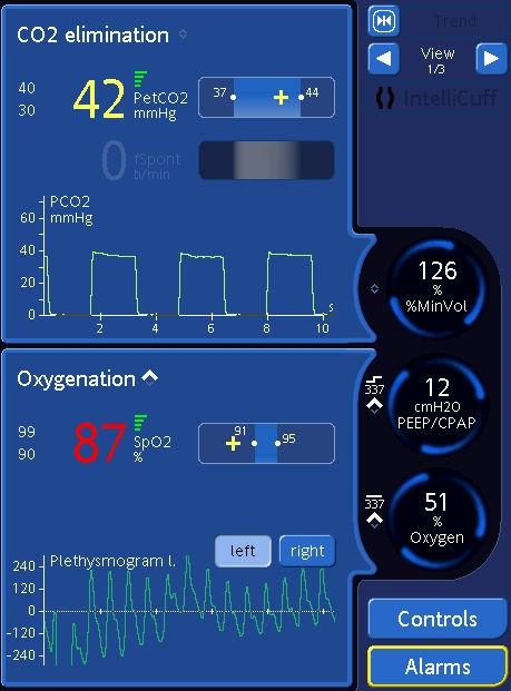 Intellivent ASV CO2 /02