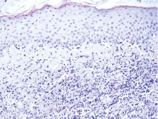 (HE), zvětšení 200, vloženo imunohistochemie CD30.