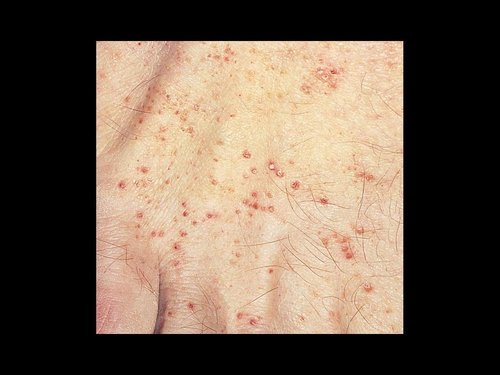 Diffuse skin involvement with petechial lesions in a patient with