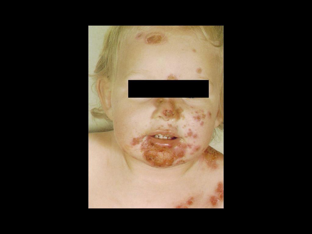 Impetigo