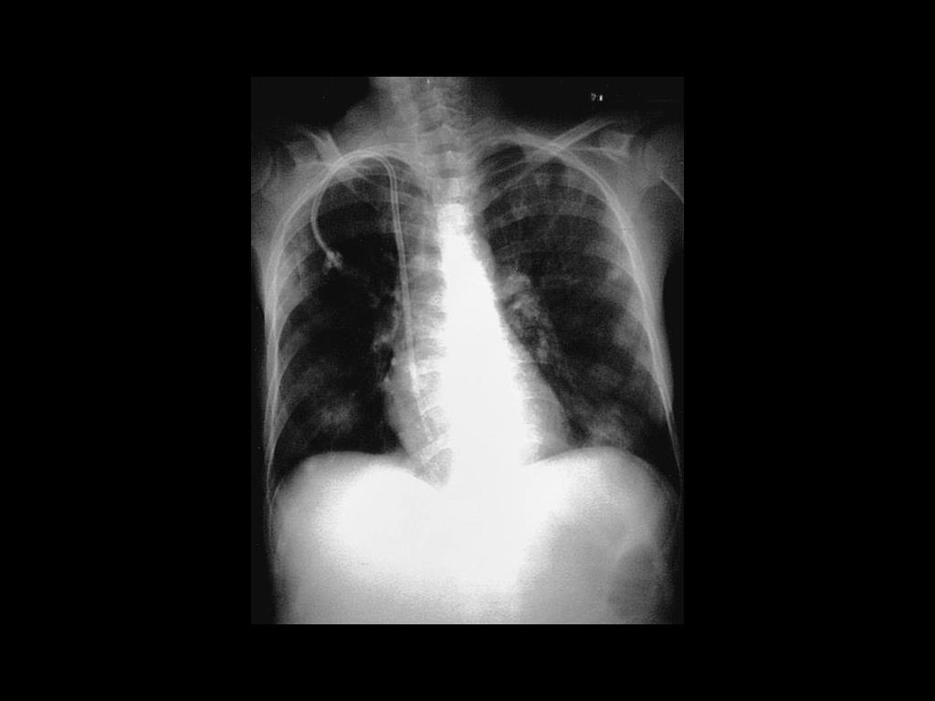 Septic pulmonary emboli. Multiple nodular pulmonary infiltrates secondary to a dialysis catheter-associated infection.