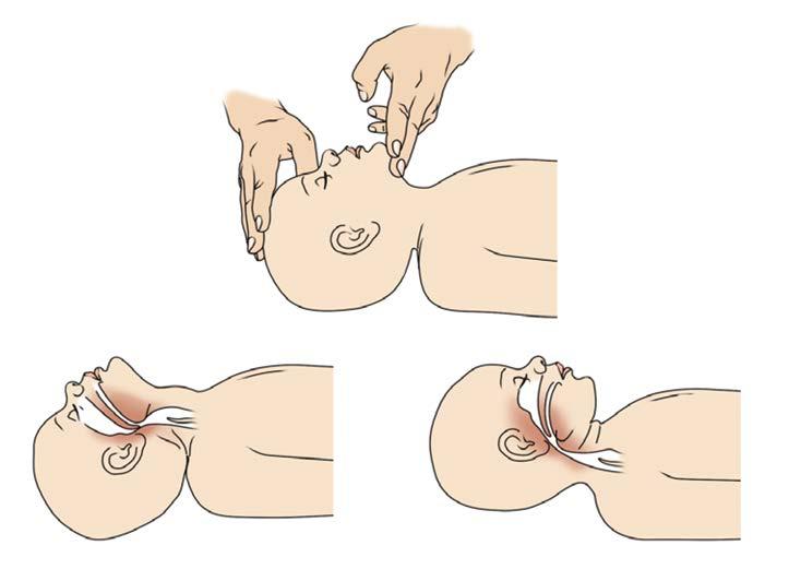 služby (při dopravních nehodách a jiných hromadných neštěstích). Obr. 2. Zprůchodnění dýchacích cest u kojence neutrální poloha hlavy.