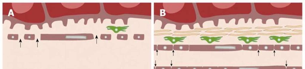 Pathophysiological differences between normal (A) and fibrotic/cirrhotic (B) liver In normal liver (A), normal fenestrae along the hepatic