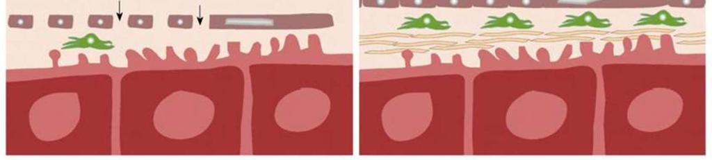 In liver cirrhosis (B), there is an increase in the number of stellate cells, associated with deposition of collagenous fibers in the Space
