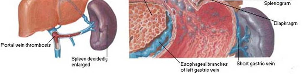 paraumbilicales caput Medusae 3) ascites a otoky přítomnost tekutiny v peritoneální dutině v důsledku portální hyypertenze + hypoalbuminémie