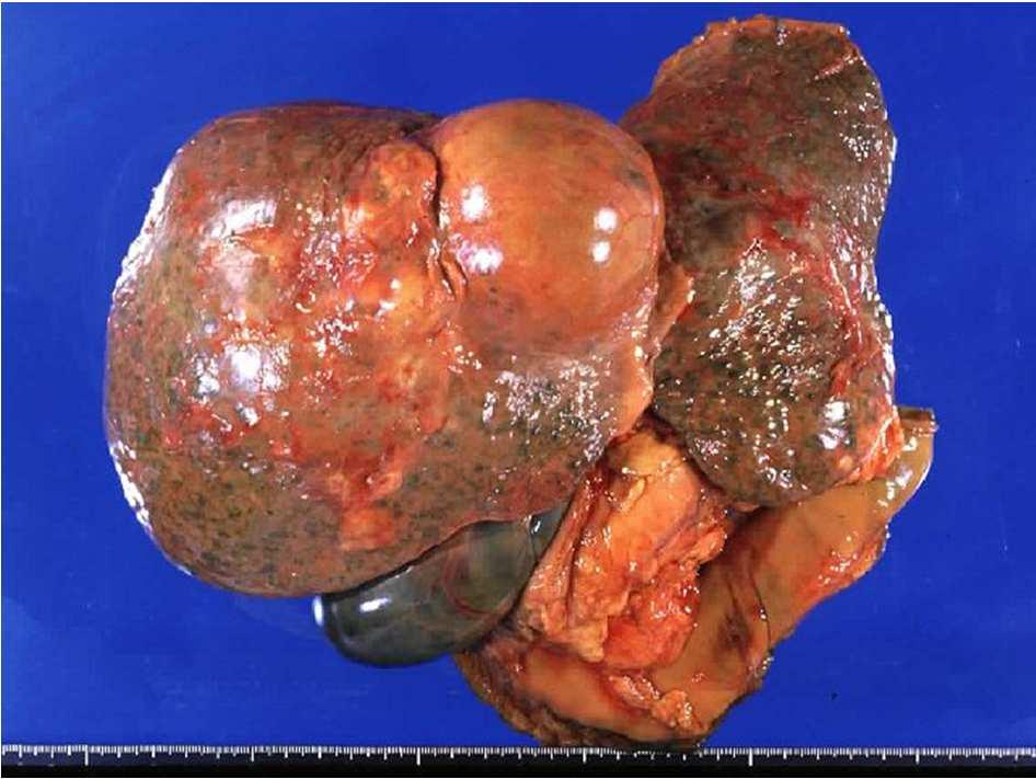 syndrom uremie jaterní encefalopatie koma ascites spontánní bakteriální