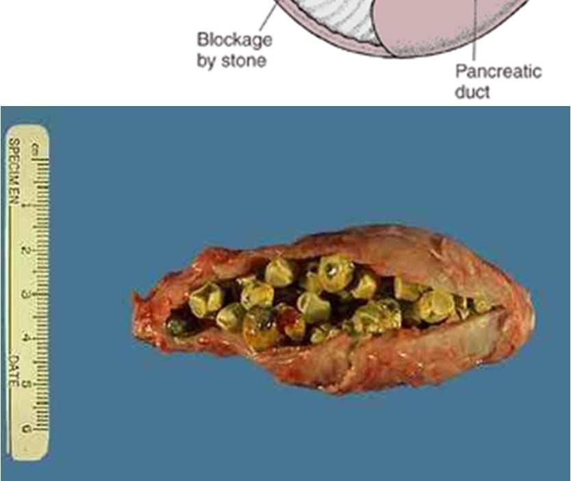 složek žluči typ konkrementů cholesterolové (70-90%)