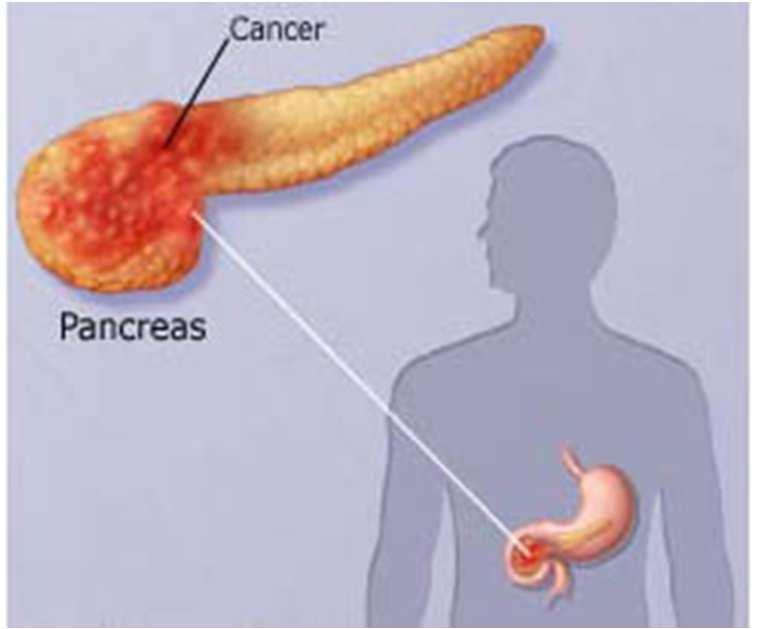 hemoragicko-nekrotická velmi závažný stav s vysokou mortalitou symptomy intenzivní bolest lokalizovaná v epigastriu a levém hypochondriu s propagací nejčastěji do zad bolest je trvalá, špatně reaguje