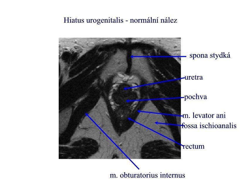 Vztah avulze musculus levator ani s prolapsem přední a zadní části bylo potvrzeno pomocí zobrazení magnetické rezonance (DeLancey JO, Morgan DM, Fenner DE, Kearney R, Guire K, Miller JM, et al.