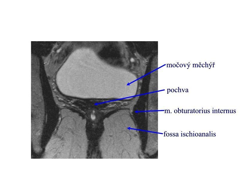 Obrázek č. 9: Frontální řez pánevním dnem v MRI zobrazení (soukromý archiv, Otčenášek, 2011).