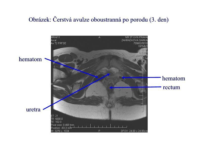 Zobrazená část levatoru tedy patří již jeho horní části, kterou v literatuře nacházíme pod označemí musculus iliococygeus. Obrázek č.
