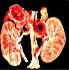 ganglia (PGL) Up to 25 % are malignant, even benign disease has high mortality