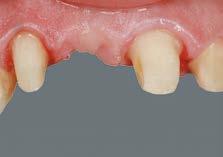 Snímání barev pomocí tyčinek s barevnými vzorky VITA SYSTEM 3D-MASTER Toothguid.