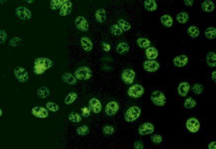 Anti Nuclear Antibodies (ANA) nespecifické, namířené proti různým jaderným, ale i