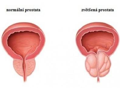 Inkontinence ochabnutí svalů pánevního