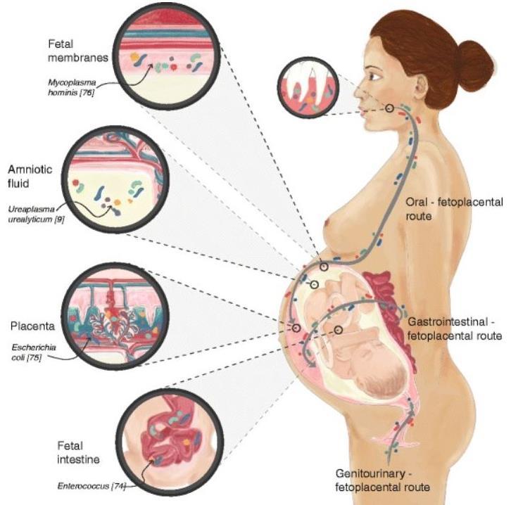 Fetální mikrobiom Prostředí plodu není sterilní Vaginální ; cervikální; amniální; placentární, fetální mikrobiom.