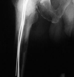 J Bone Joint Surg Am.