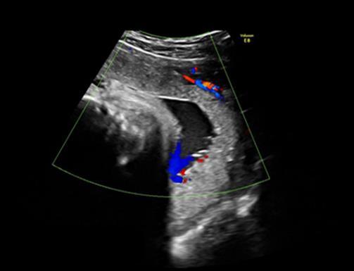vnitřní branky obvykle není třeba další vyšetřování vcestného lůžka. Do porodu se placenta obvykle vytáhne mimo oblast vnitřní branky.