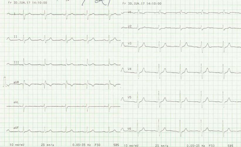 550 Oběhová zástava u pacienta s významnou PR po chirurgické valvulotomii Obr. 8 EKG dva roky po operaci sinusový rytmus a RBBB s užším komplexem QRS. RBBB blokáda pravého Tawarova raménka.