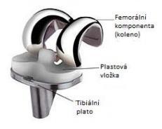 APLIKACE METOD RP PŘI VÝROBĚ IMPLANTÁTŮ 2 APLIKACE METOD RP PŘI VÝROBĚ IMPLANTÁTŮ Implantát je uměle vyrobená medicínská pomůcka, která je vyrobena z biokompatibilních materiálů.