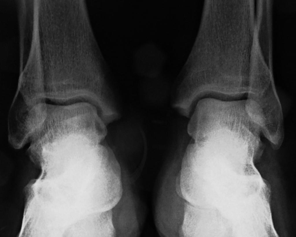 The common foot problems [1, 2, 3, 4, 5, 6, 7, 8, 9, 10, 11, 12] and ankle joint pathology connected with the getting off the car [15, 16, 17, 18] There are three main conditions of the pathology as