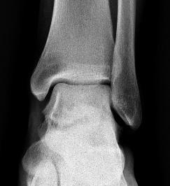 Fig. 4: Case 4. A man, 25 years. Pain of the left foot and swelling 3 years. Many consultations but no proper diagnosis and no proper therapy.