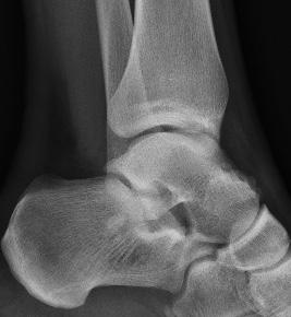 We advise the prophylactics ma - nagement and proper physiotherapy.