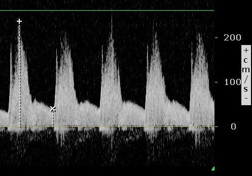 Pulzatilní levo-pravý zkrat široce otevřenou dučejí Bidirekční zkrat s arteriálním