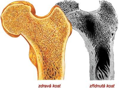 Osteoporóza ovlivnitelné faktory (ŽS - strava (Ca, Mg, vit.